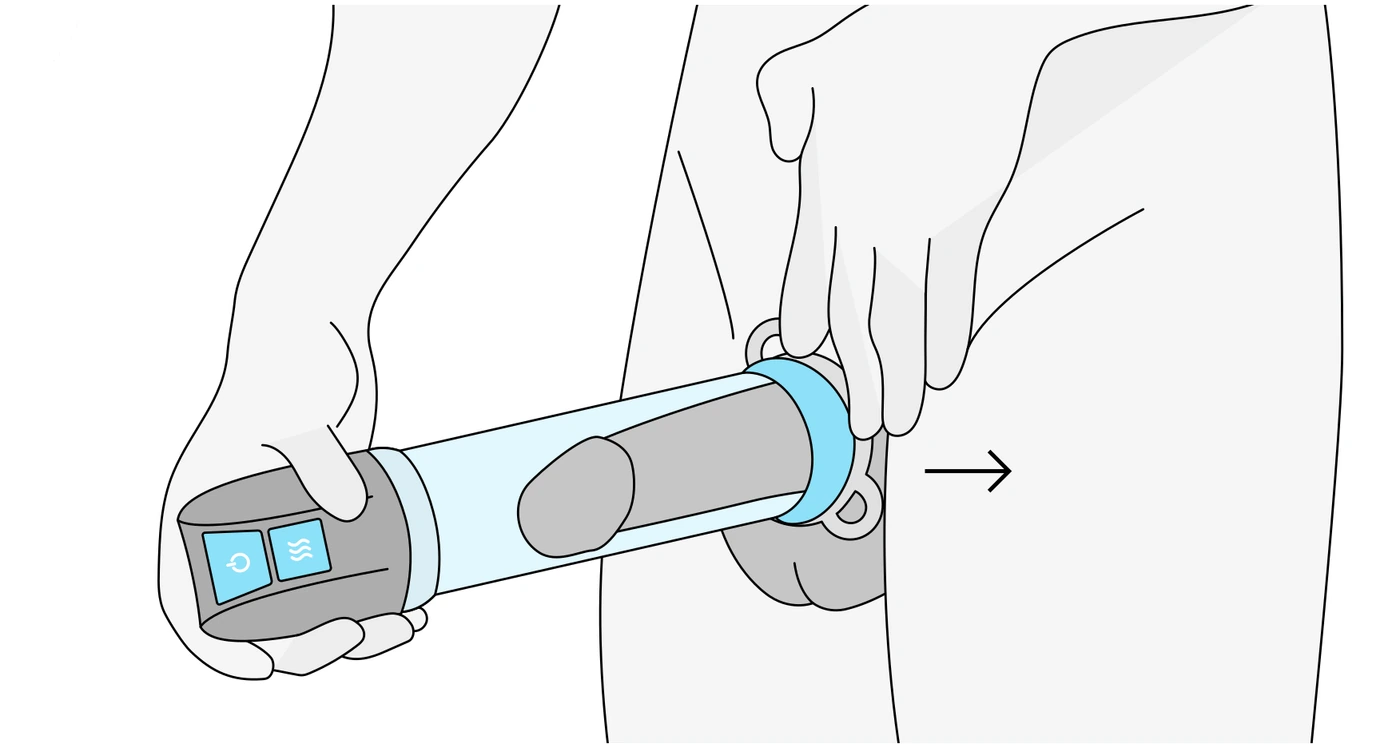 Konstriksiyon halkası kovandan penisin üzerine, penis köküne doğru itiliyor