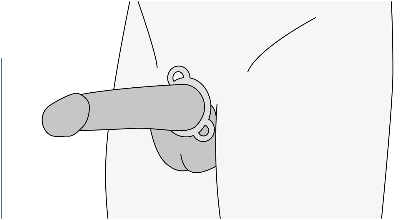 Cihaz çıkarılmış; konstriksiyon halkası penis kökünde duruyor